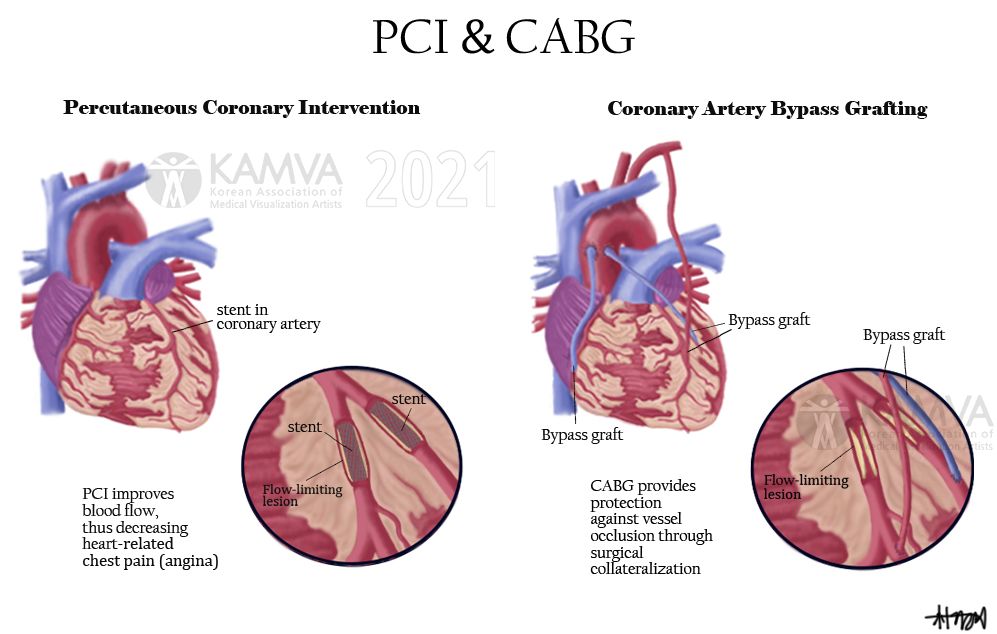 S-박기려_PCI_CABG.jpg