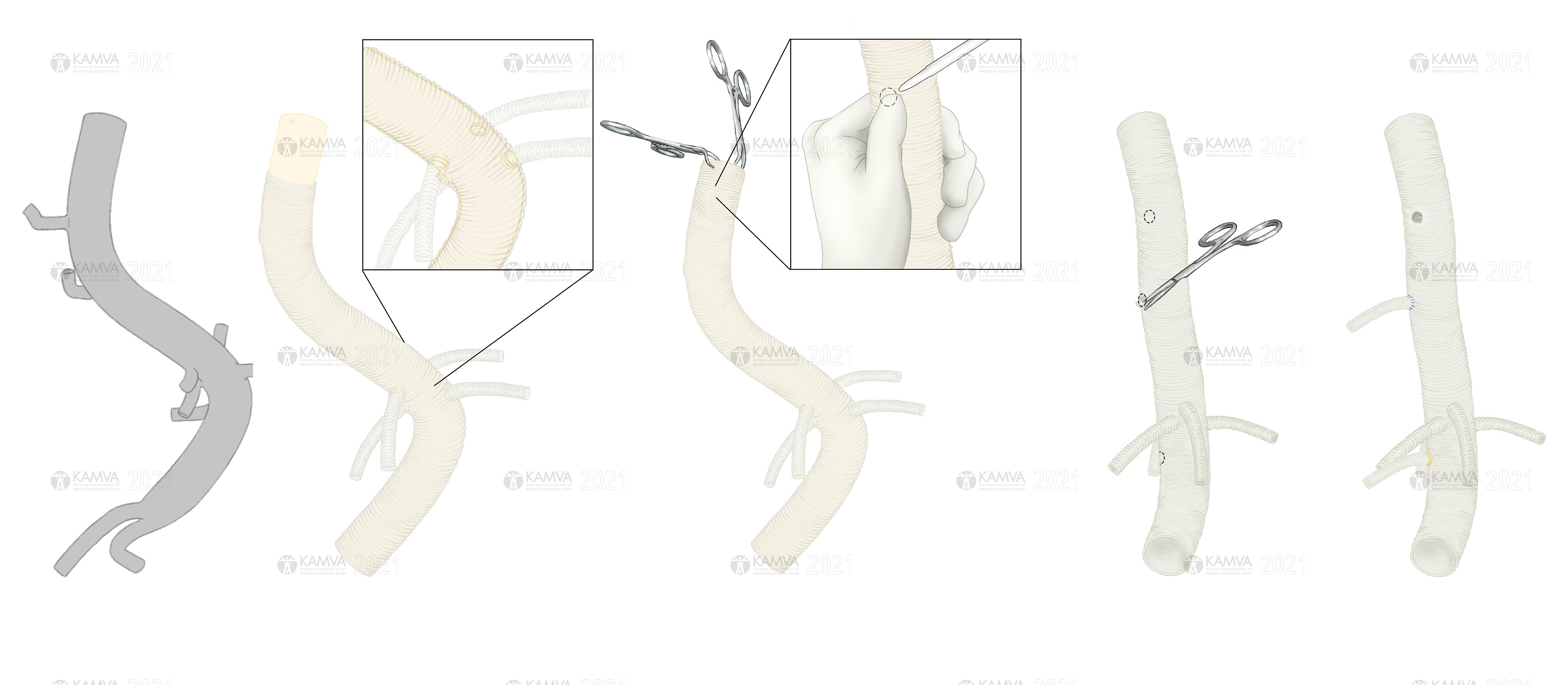 P-김민경_Aortic reconstruction process.jpg